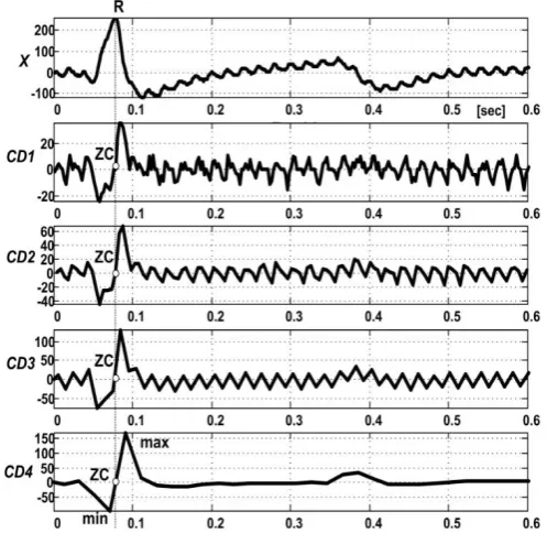 Fig. 2. QRS detection using wavelet decomposition based on FST. Signal X[n] is sampled by 800 Hz