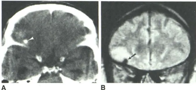 Fig. 5.mm -Case 5. A, Unenhanced CT scan shows calcification (arrowhead) just above right 