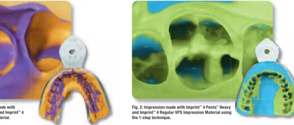Fig. 1: 1-step technique impression made with  Imprint ™  4 Penta ™   Super Quick Heavy and Imprint ™  4  Super Quick Light VPS Impression Material.