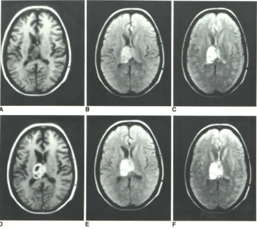 Fig. 6.-Grade Maximal enhancement III astrocytoma. Pre- (A-C) and post- (O-F) enhancement IR 1500/500/44 (A and 0)