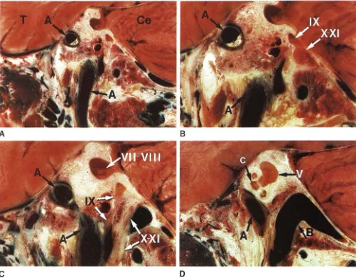 Fig. 1 in and within carotid canal. B, Magnification together, to Parasagitlal cryomicrotomic sections of jugular foramen from medial lateral