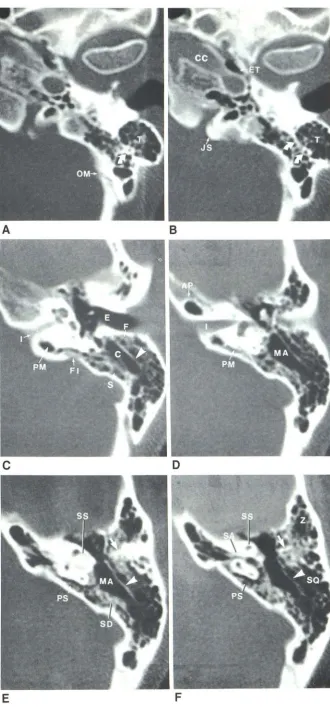 Fig. 3.-Axial passes anteriorly below internal auditory canal (MA) is visible. Medially, central tract cells (SD) are seen, laterally squamosal cells auditory canal
