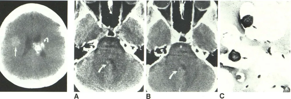 Fig. virtually free of blood cells. Dense intraluminar structures hemangioma with thick bands of interstitial collagen