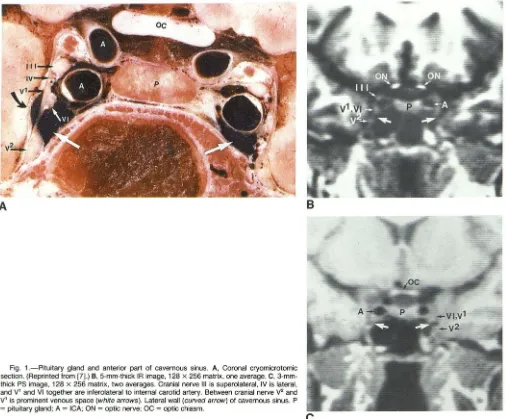 Fig. 1.-Pituitary section. (Reprinted from [7].) gland and anterior part of cavernous sinus