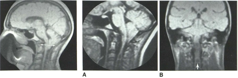 Fig. 5.Coronal image. Large cervical hydromyelia cavity with prominent transverat Peglike tonsils positioned below C1-C2 -SE 700/40 images in patient with Chiari I malformation and hydromyelia