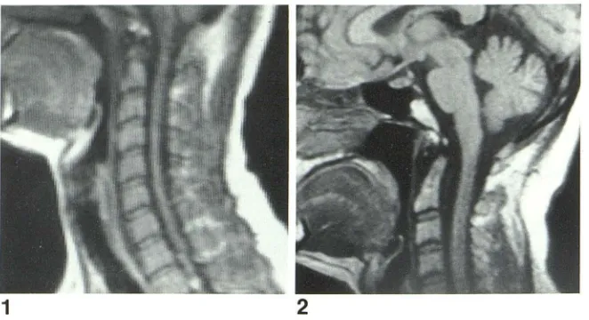 Fig. 1.using -Sagittal SE 500/30 image. Normal study body coil. Inherently lower SIN ratio compared 