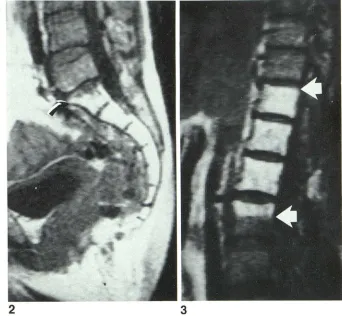 Fig. 3.Increased signal intensity of -Case 3. Midsagittal SE 530/30 image. T1 0-T12 vertebral 