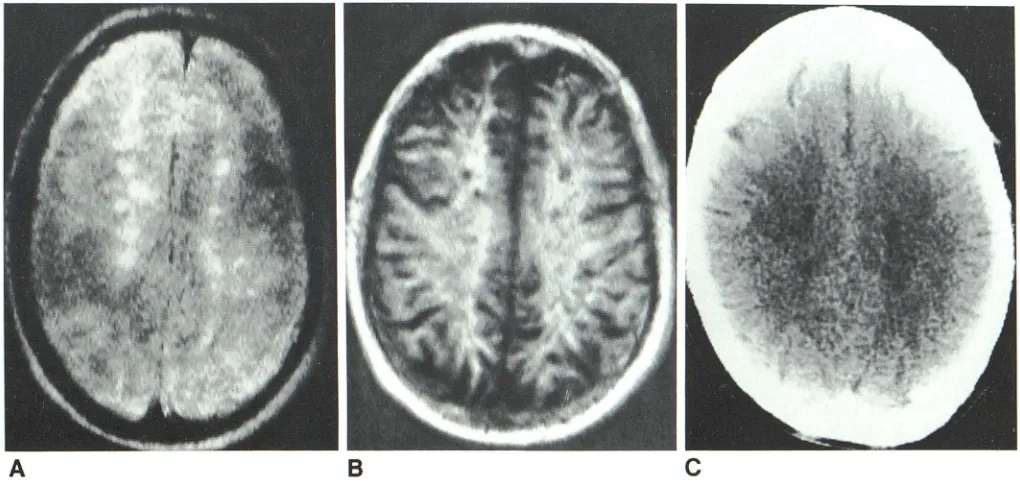 TABLE 2: Efficacy of MR Scan Technique and Distribution of Lesions 
