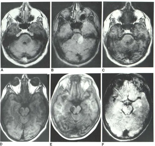 Fig. ce120/1000. rebe6.- Two patients with brain stem lesions. Region of abnormality in left llar peduncle seen on three 3D volume techniques: A, SE 30/250