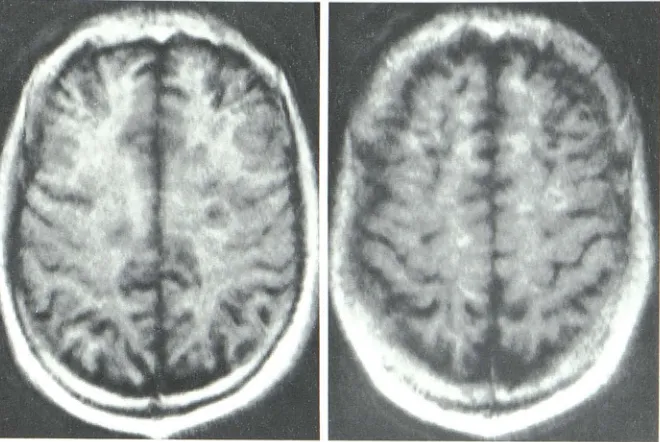 Fig. 8.-Sagittal (A) and coronal (B and C) sections from two patients with multiple sclerosis