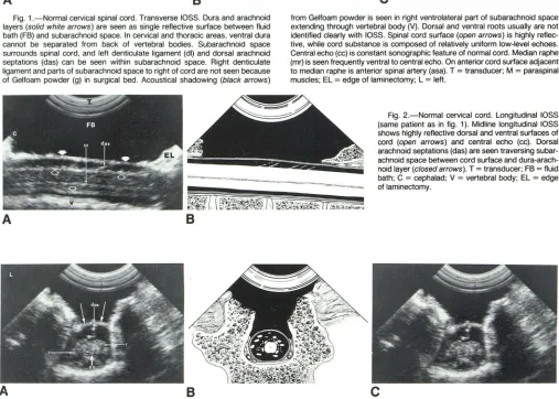 Fig. 2.(same patient as -Normal cervical cord. Longitudinal lOSS in fig. 1). Midline longitudinal lOSS 