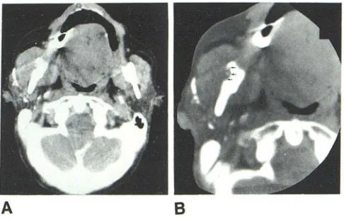 TABLE 1: Buccomasseteric Region: Pathologic Entities Studied with CT 