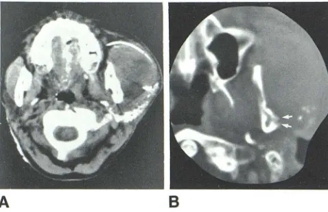 Fig. right-sided, firm cheek mass. 