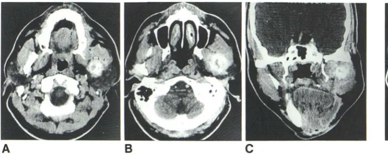 Fig. 10.ns-69-year-old man with left illar region and left cheek mass. 