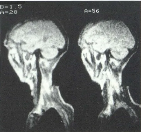 Fig. 6.-image. Internal carsinus and either pitulnternal carotid arteries and cavernous sinus, coronal spin-echo otid arteries have no signal