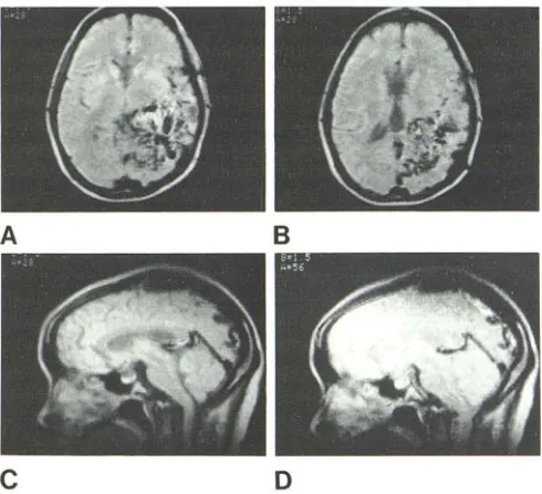 Fig. arrow) of mal righl internal l11 .-Occluded left carotid artery, transverse spin-echo image