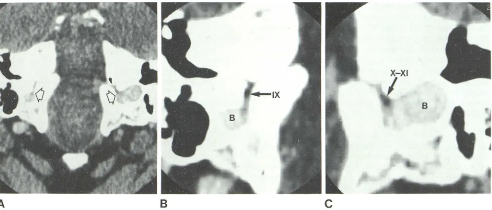Fig. 8.-Pinars vascularis (V) and jugular bulb (8) in CT sections - 15 0 to CML. A is from dried skull embedded in paraffin; B is a patient after infusion of travenous contrast agent