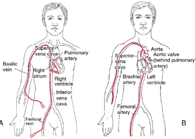 Figure 1.1. An illustration of cardiac catheterization.  A: Right-sided heart catheterization