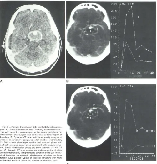 Fig. 2.ve pattern typical of vascwash in and markedly washout phase and smaller recircn