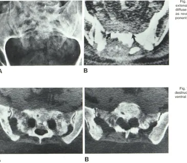 Fig. 5. -Chordoma. ponent as revealing ventral and diffuextensive A. Plain film demonstrates destruction of sacrum 