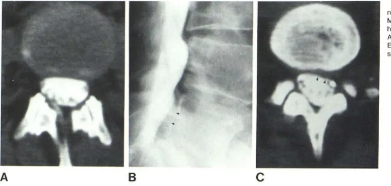 Fig. 8.-AExtruded disk fragment with Myelogramhind vertenent disk at Lsion After , Metrizamide CT