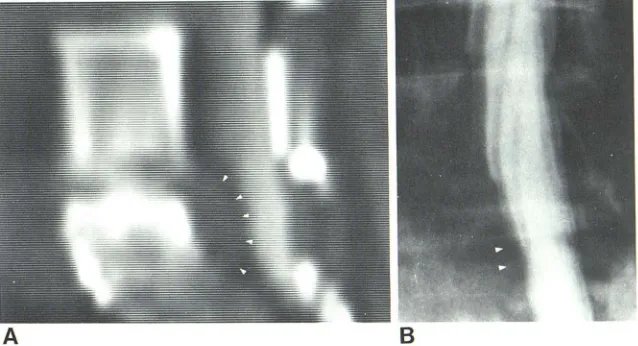 Fig. 9 .S 1 nerve rObtruded -A, Metrizamide CT. Extremely large ex-disk on oblique format (arrowheads)