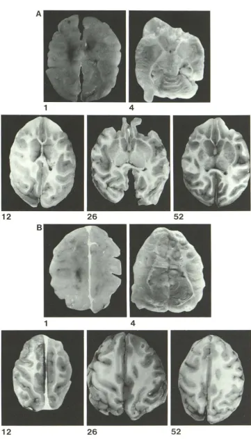 Fig . 3.-Grand oss specimens. Frontal occipital (A) and parietal (B) white 
