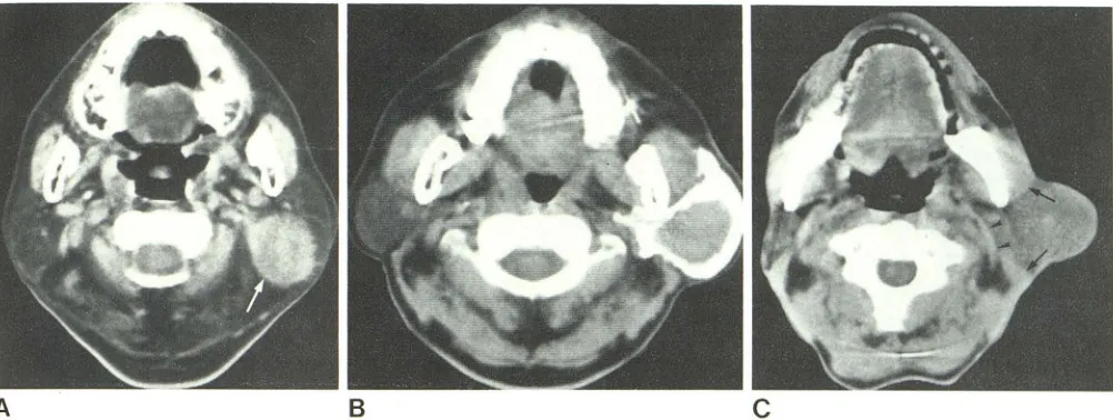 Fig. 5.-slightly irregular margin in CT. tumor in superficial part of letu mor on CT appearances of parotid tumors