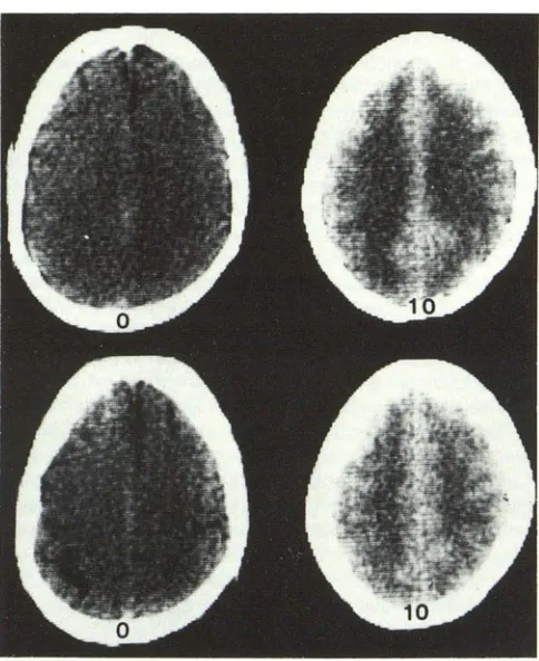 Fig. 18from CSF into brain also lipid insoluble indiabnormality by absence metrizamidbefore brain substance