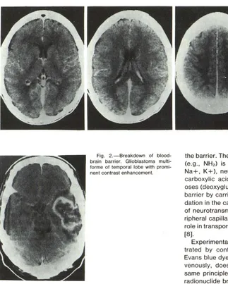Fig. 2.-Breakdown brain barrier. of blood-Glioblastoma multi-