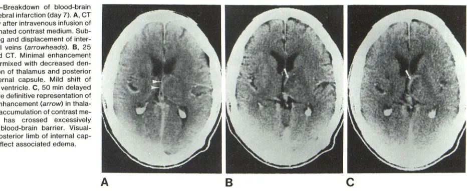 Fig. 3.-Breakdown barrierof blood-brain , cerebral infarction (day 7). A, CT 