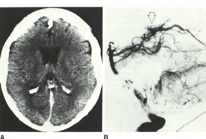 TABLE 1: Precontrast CT Appearance of Vascular Malformations of Brain 