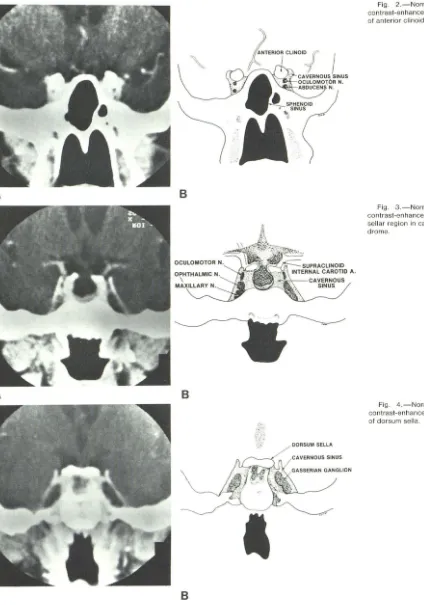 Fig . 4.-Ncoof ntrdorsum ormal cavernous sinus, ast-enhanced coronal scan, at level sella