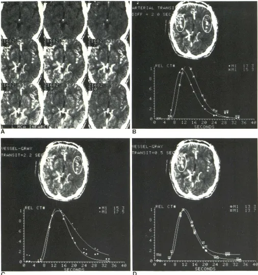 Fig. 15. -Case normartery sttransit differen3, 56-year-old woman who had acute left middle cerebral roke 3 days before