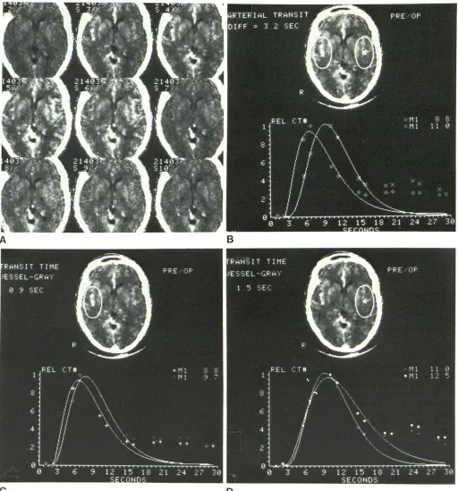 Fig. 1 O.-Case 1, 5 1-year-old woman with left siphon stenosibolus right of 2.4 sec segmented images from s