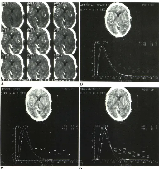 Fig. 11 nartery bypass. A, Rapid scan series. B, Arterial transit ow .-Case 1, 5 months after superficial temporal-middle cerebral (0 = righi, x = left) differs by only 0.4 sec (versus 3.2 sec on preoperative study)