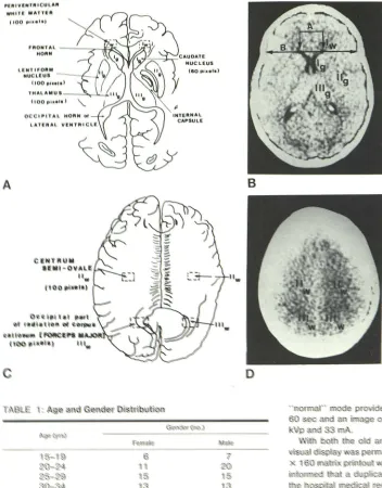Fig. 1.-A and B, 3A leve(forat level of frontal horns (BWhite matter sites ventricular span (A):ulcleus), and sites, I, (caudate nar white matter l