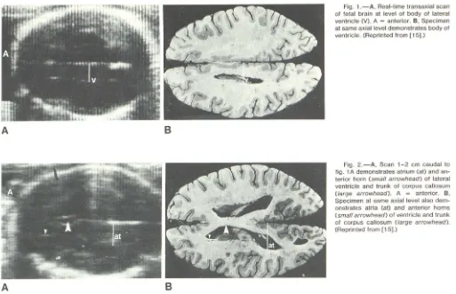 Fig. 1 ., Real-time transaxial scan at same axial level demonstrates of veventricle. (Reprinted from ntriclof lateral e (V)