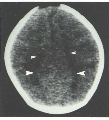 Fig. 5.heads) slitlike -CT scan of normal neonatate demonstrates body (small arrowheads) and atria (large arrow-of lateral ventricles