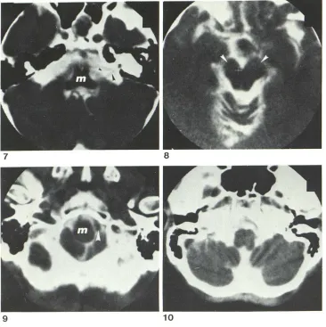 Fig. 7.-At (m). Cranial nerves 7 level of upper medulla (small arrowhead) 