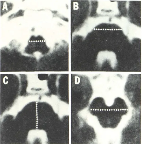 TABLE 2: Normal Brainstem Measurements 