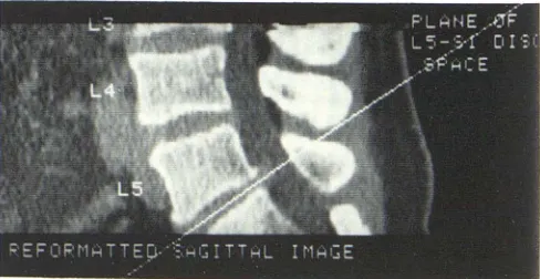 Fig. 1.-Axiais made lumbosacral spand boxes represent axial images. Slice A represents a nomimics herniated l CT slices of lumbosacral spine can give images of normal ine that have different appearances depending on where slice in relation to spinal curve