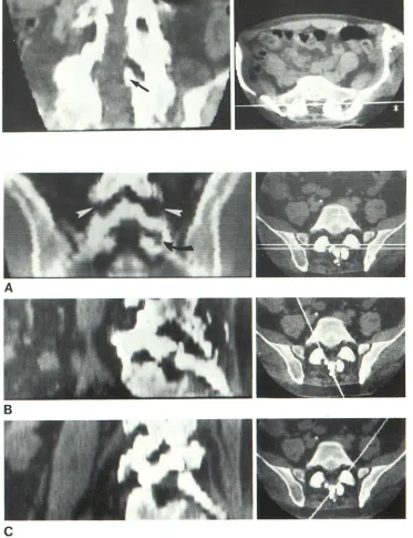 Fig. 7.lu-Reformatted coronal image mbar spine. Bone spur (arrow) and 
