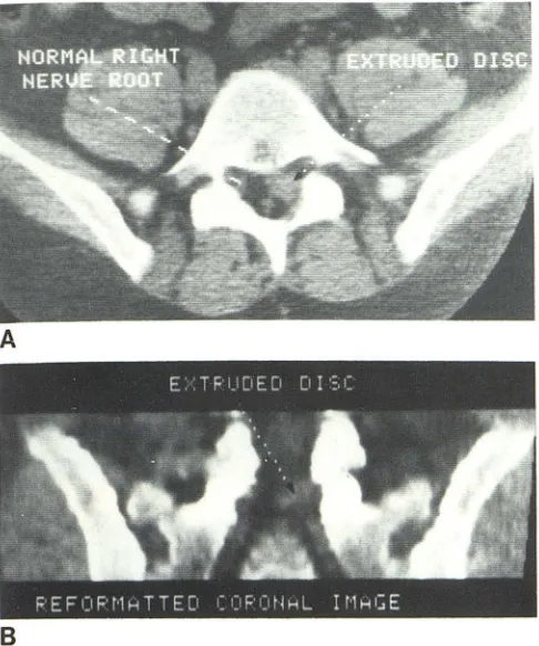 Fig. 9.-A, through pulposus oDirect axial CT image through L5-S1 level. Herniated nucleus bliterates nerve root (arrow)