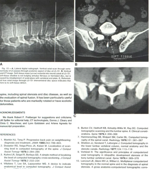 Fig. 10.-Acaused by misalignment of axial plane with verteSoaxiat CT image. Soft-tissue mass t d true axial image through Lthbral boere is no soft, Lateral digital radiograph
