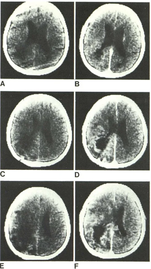 Fig. 2.-Cologin the poorly and ase 6: cardiac transplant with aspergillosis. Before (left column) after (right column) contrast infusion