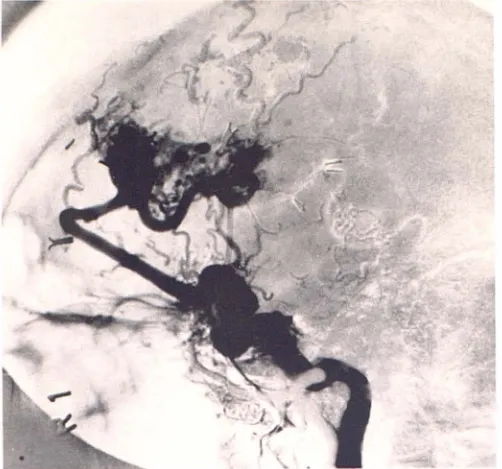 Fig. 7.-A, scan Radionuclide flow after fourth embolization. (Ct. 