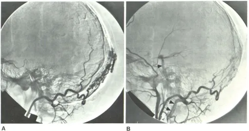 Fig. 3.-Lateral view, magnification, sand potential pathway for emof this scalp arteriovevessels as emboli were introduced at normal perfusion pressubtraction technique