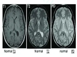 Fig. 1. Normal brain MRI images 