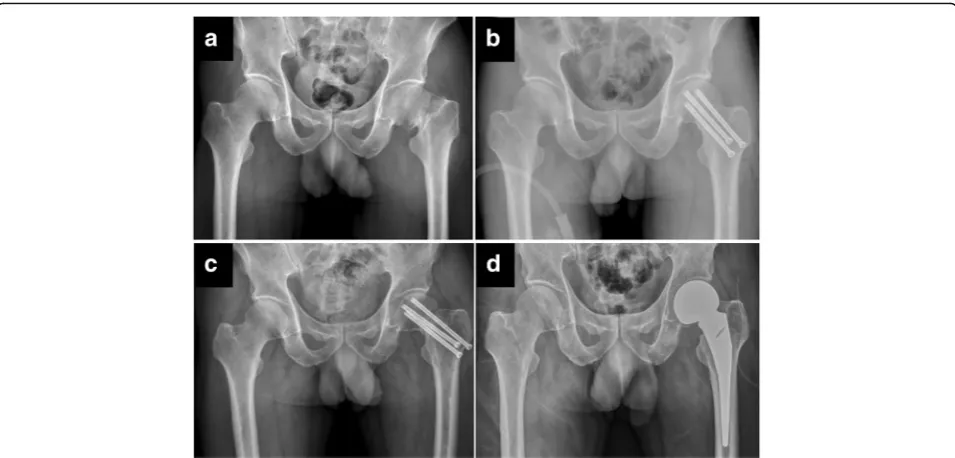 Fig. 1 A typical clinical course of failed internal fixation in middle-aged patient.sustained a left displaced femoral neck fracture